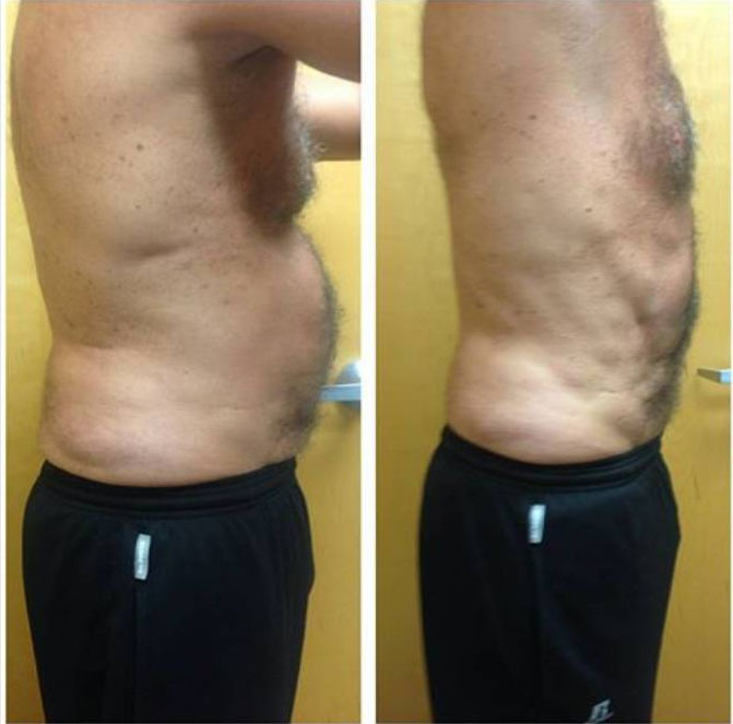 Cavi Lipo Before And After Photos